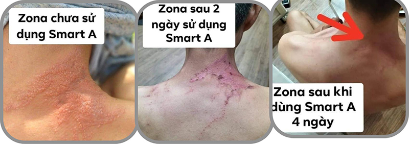 nước muối điện phân smart a