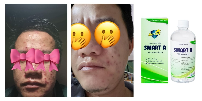 smart a trị mụn được không