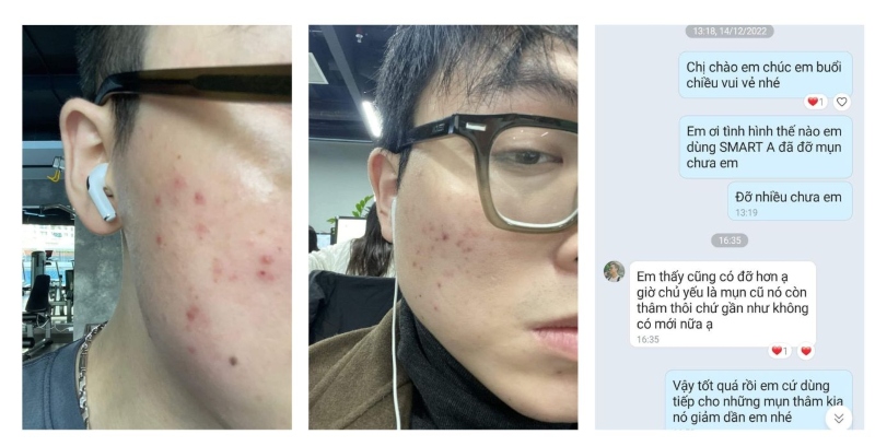 smart a trị mụn được không