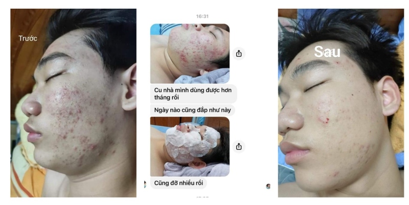 smart a trị mụn được không