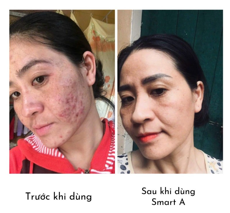 smart a trị mụn được không